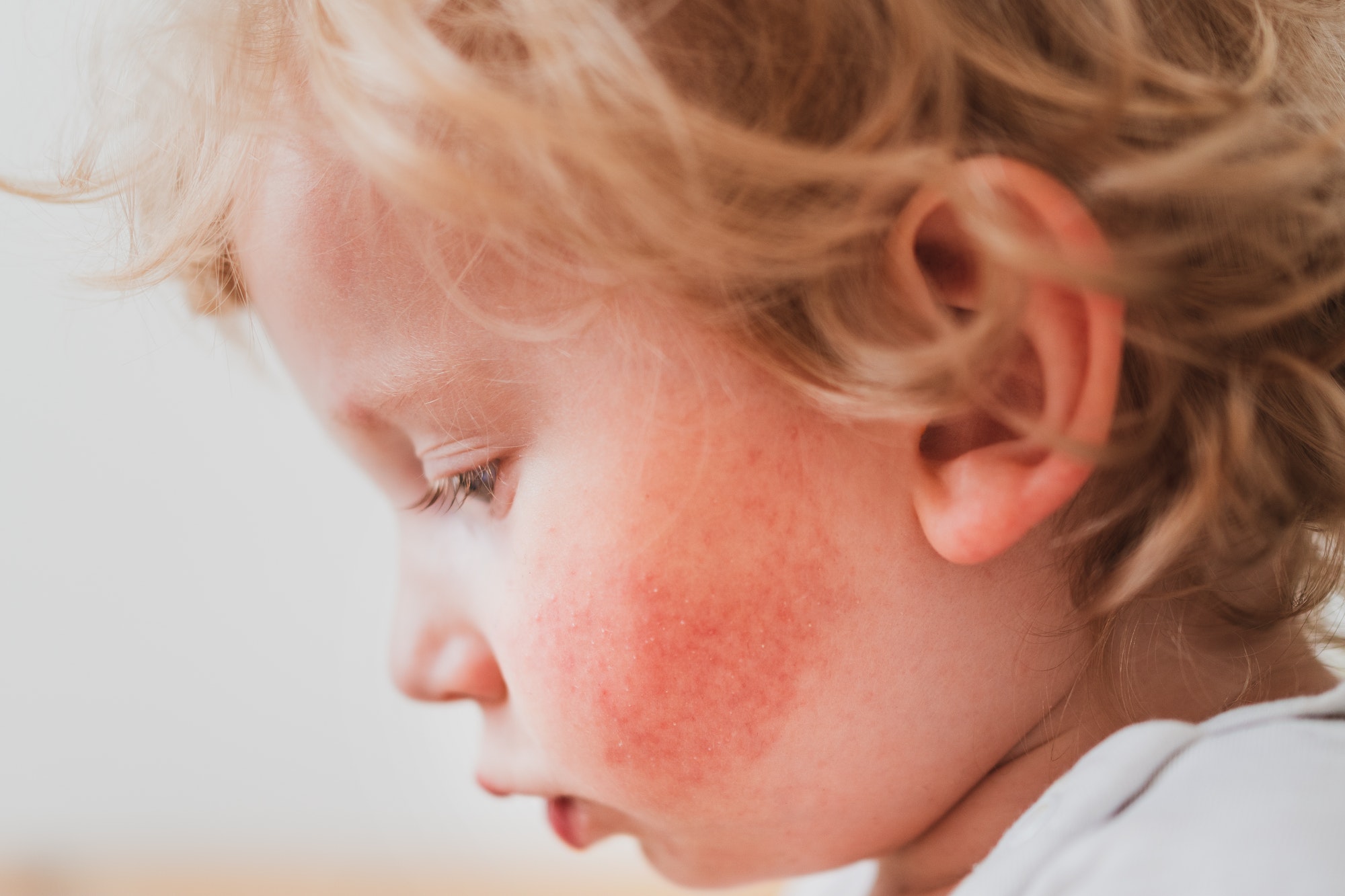 food allergies, eczema, or diathesis in a small child on the cheeks